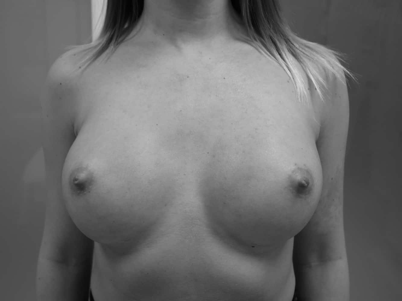Breast enlargement - after surgery